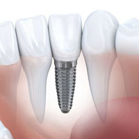Dental Implantology